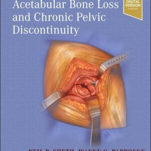 Treatment of Acetabular Bone Loss and Chronic Pelvic Discontinuity, 1st Edition